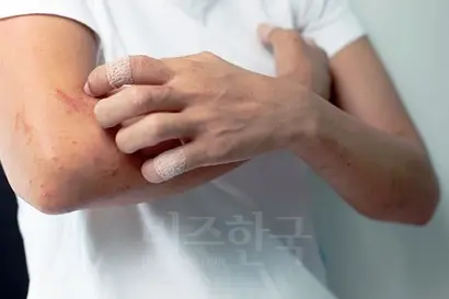 환자들의 바람과는 달리 국내에서는 듀피젠트의 급여 적용이 이뤄지지 않고 있다. 이를 두고 아토피피부염 환자들은 국민신문고에 민원을 제기하며 급여 적용을 요구하고 있다. 사진=미국 국립아토피협회(NEA)