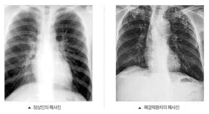 우리나라는 결핵 발병률이 경제협력개발기구(OECD) 회원국 가운데 1위라는 오명을 갖고 있다. 사진=대한결핵협회 홈페이지 캡처