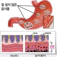 이면조직 손상 과정. 사진=최서형 제공
